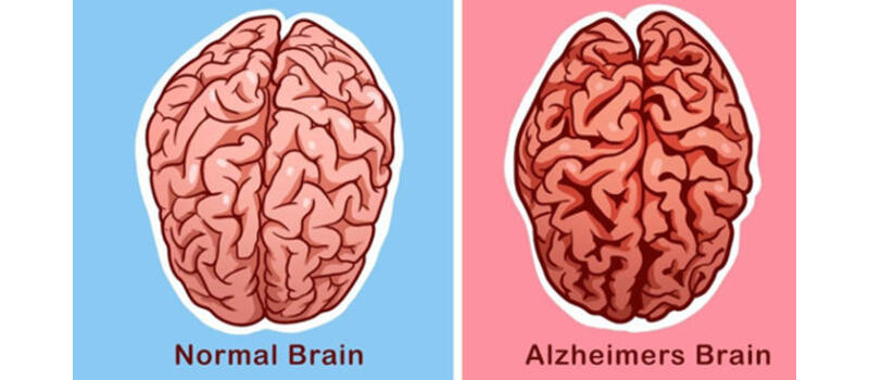 alzheimer's