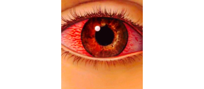 eyes infection