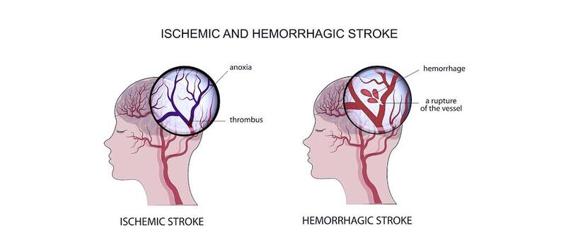 mental health issue strokes